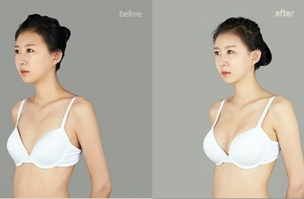 πριν και μετά την πλαστική αυξητική στήθους